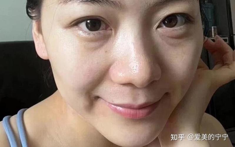 580元去眼袋是真的吗知乎