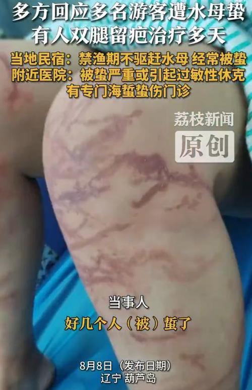 水母蜇人的照片