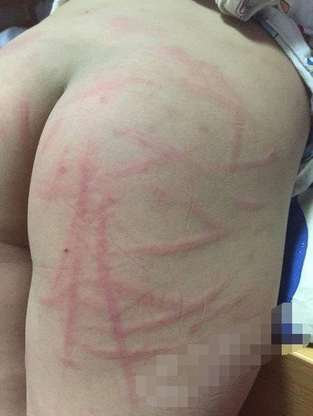 小孩打屁股白打到红