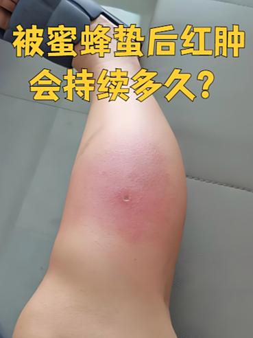 大蜜蜂蜇人后会怎么样