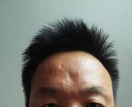 右侧额头有一道凹陷的面相