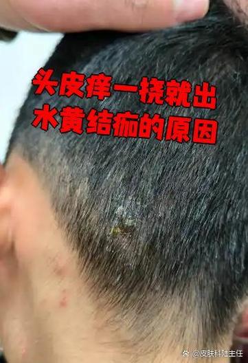头皮一挠就出水是怎么回事