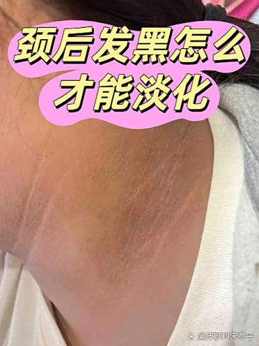 黑棘皮病是怎么治疗