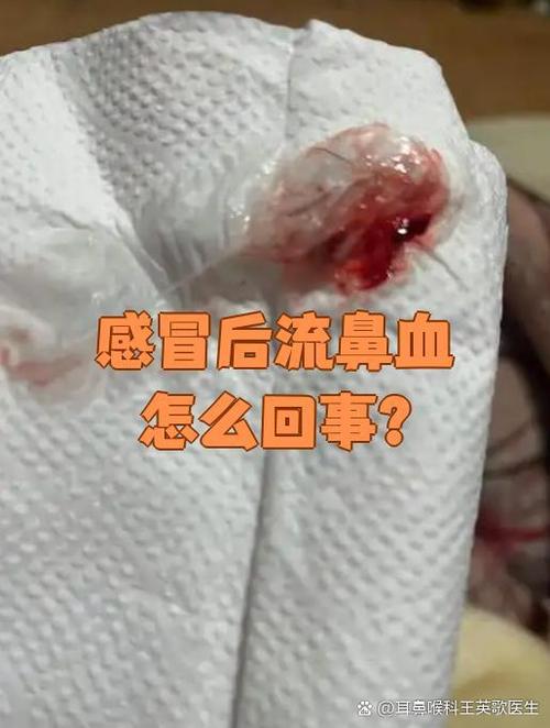 发烧流鼻血怎么回事