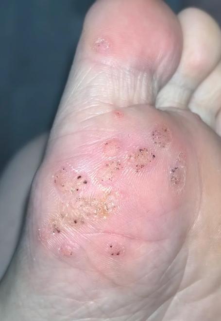 治疗跖疣的最佳方法