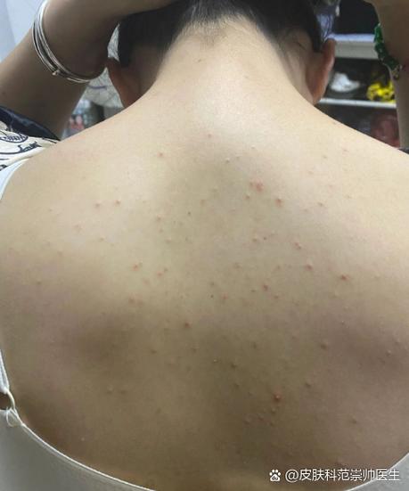 长痘痘的说说幽默