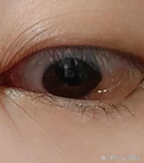 眼睛雾蒙蒙