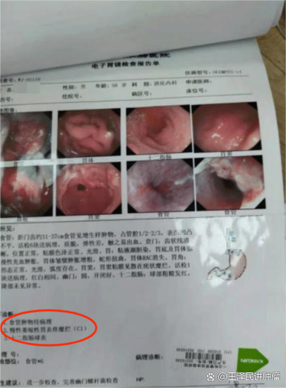 食道肿瘤前兆