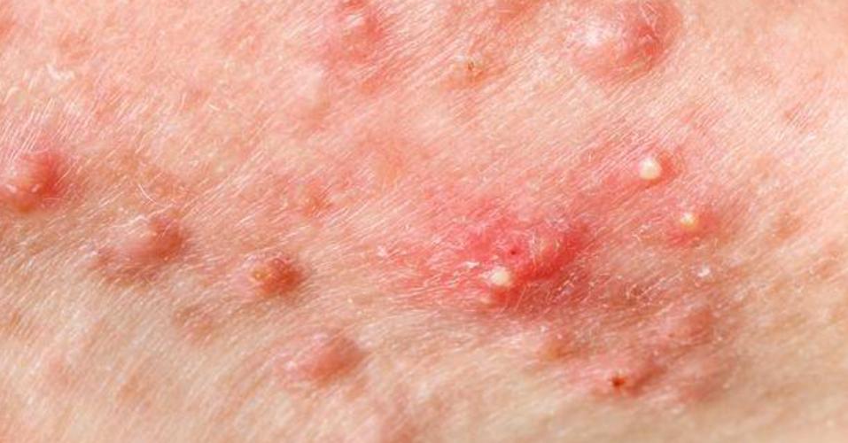 hpv感染红疹子图片