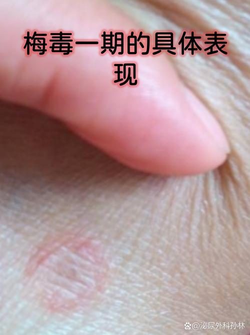 梅毒免费24小时咨询