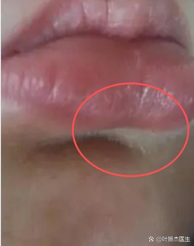 下嘴唇中间白了一块是怎么回事