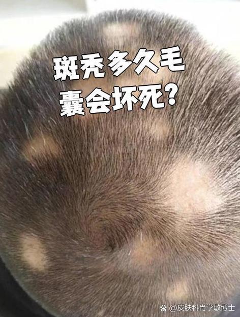 斑秃一般打几针才长头发