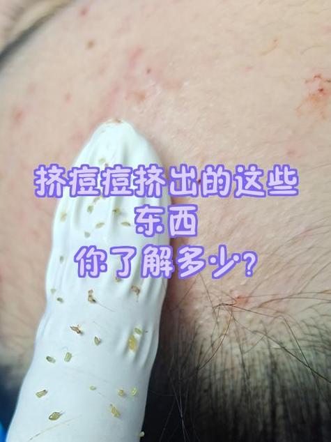 挤痘痘是什么意思 暗语