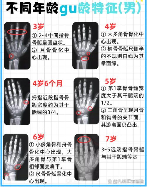 骨骼闭合一般在多少岁