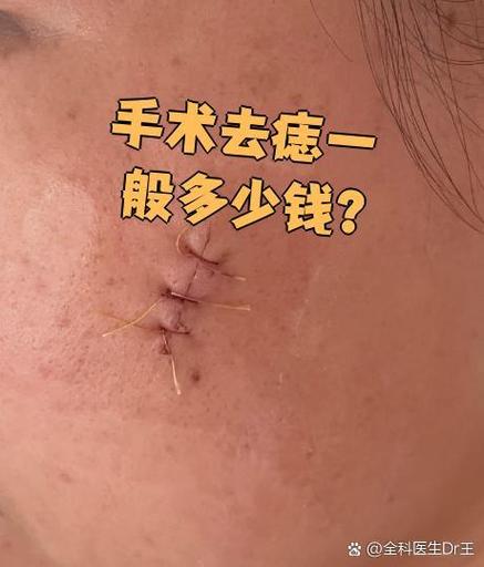 济南军区总医院祛痣