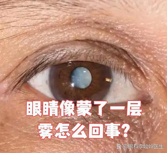 眼睛有一层雾蒙蒙的感觉
