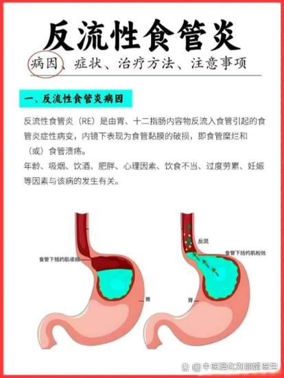 食管反流是什么症状表现