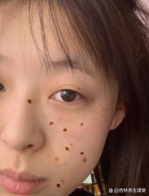 去痣的方法