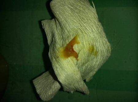 绿色的鼻涕是病毒感染吗