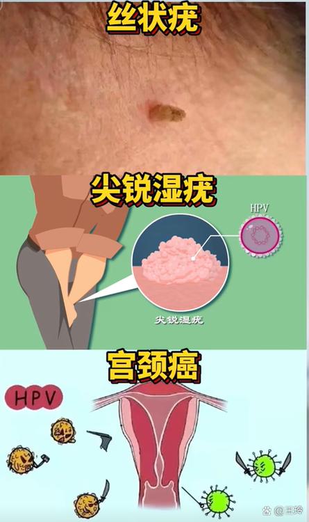 人乳瘤病毒感染是什么病