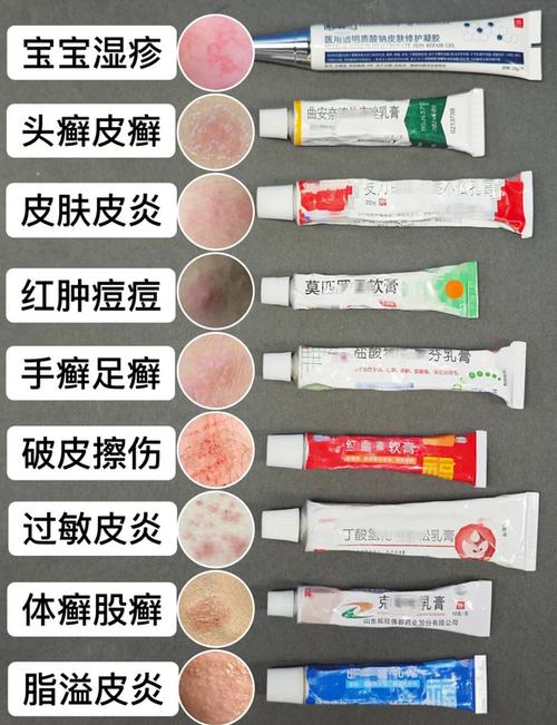 湿疹专用软膏