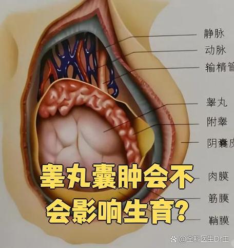 睾丸囊肿