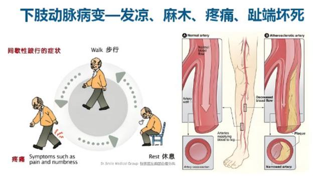 下肢血管闭塞做什么检查