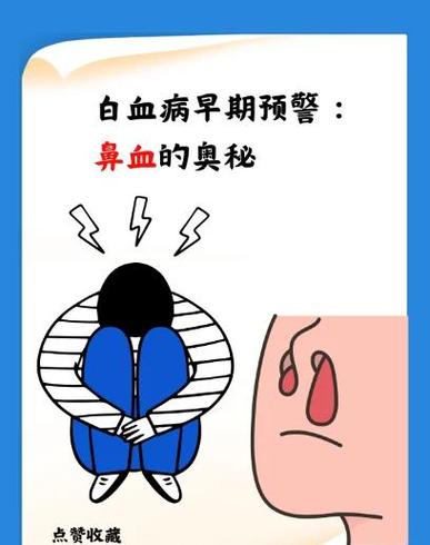 光流鼻血是白血病吗