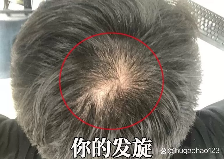 头顶漩涡脱发还能长吗