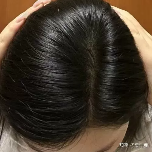 发旋头发少怎么变浓密