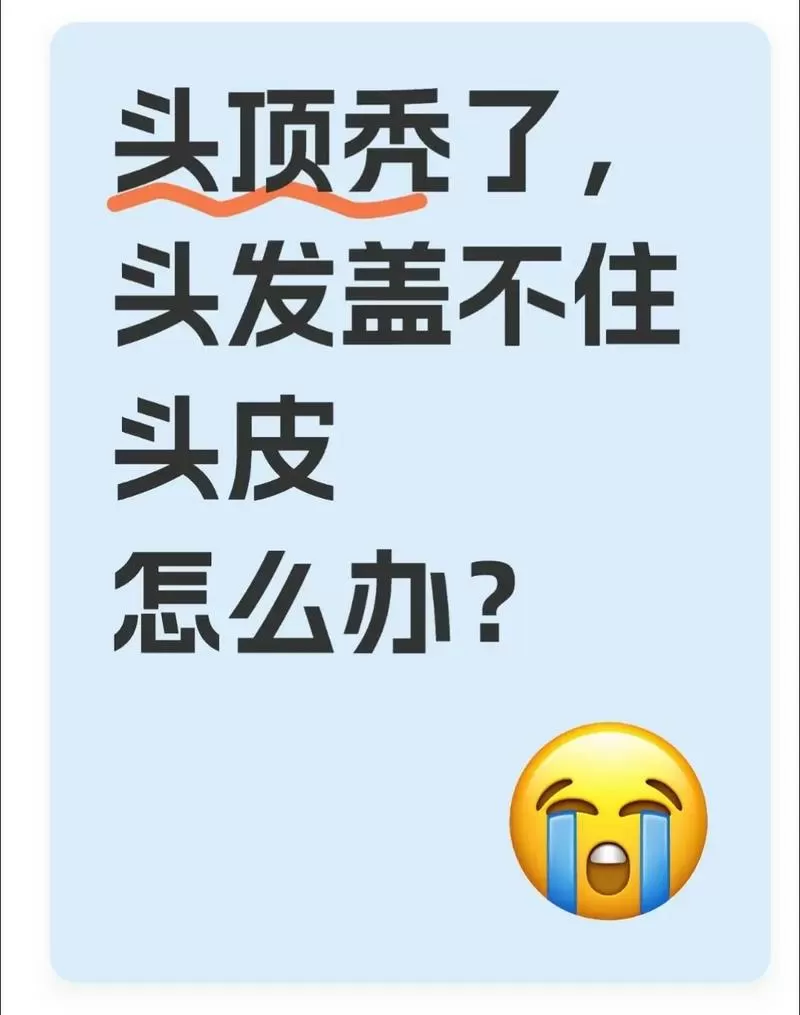 头顶秃怎么办
