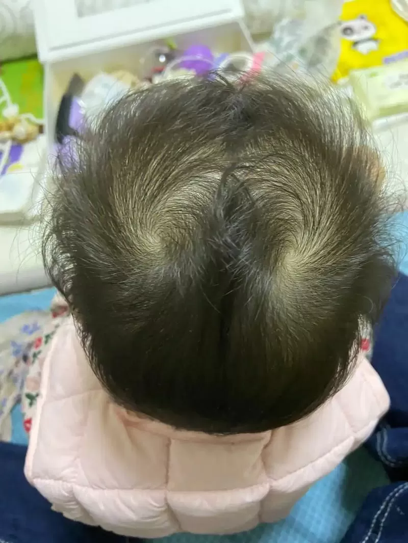 孩子的头旋遗传谁