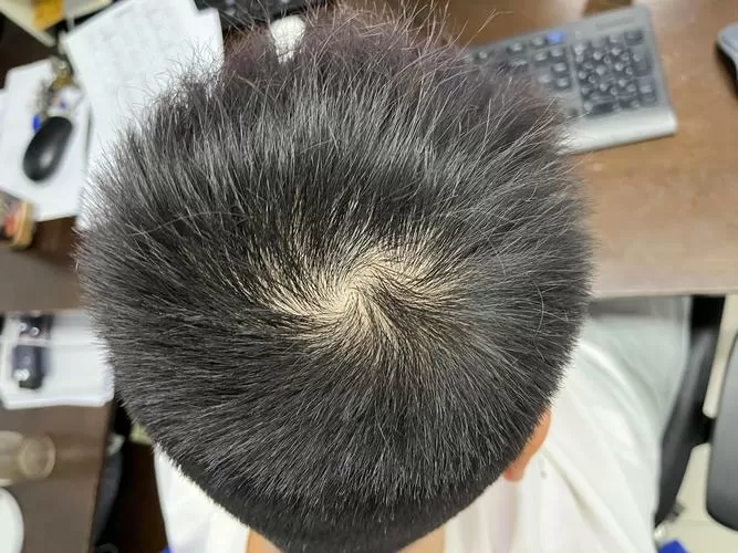 16岁头发漩涡处头发稀少秃顶