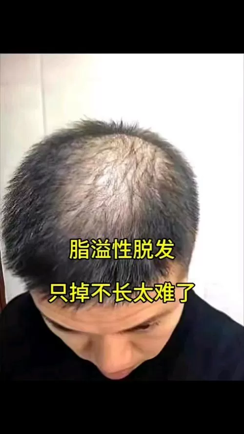 脂溢性脱发只掉不长吗