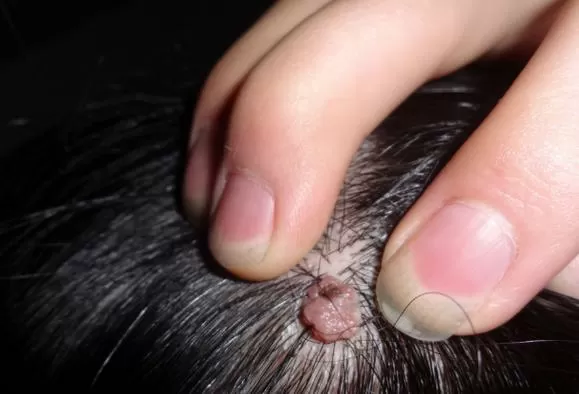 头皮上长粉色肉凸起