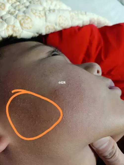 脸过敏起小白点能挤吗