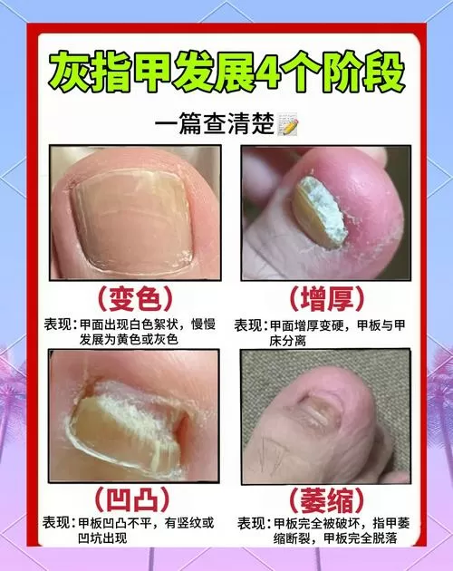 灰指甲要剪到什么程度