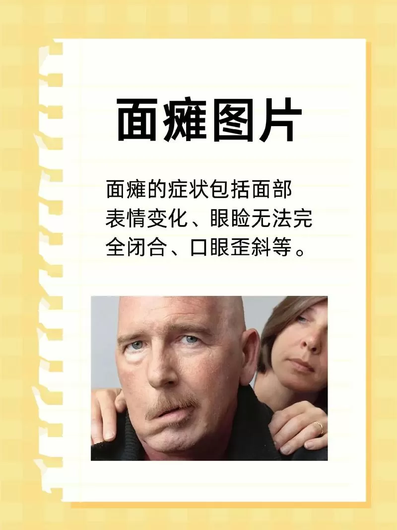 治疗嘴歪眼斜小偏方