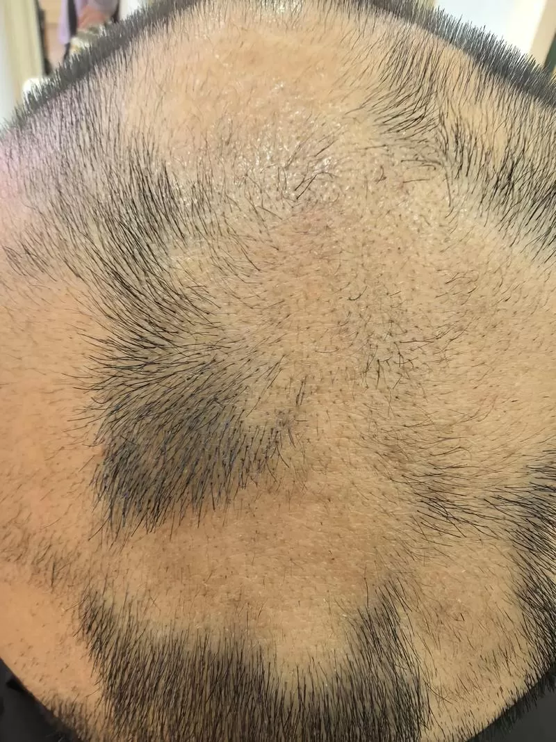 斑秃用针刺能长出头发吗