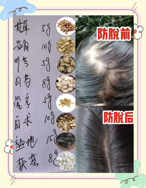 掉头发怎么办最有效的偏方