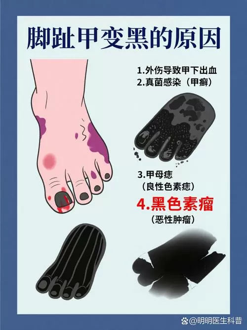 脚丫子黑怎么回事啊
